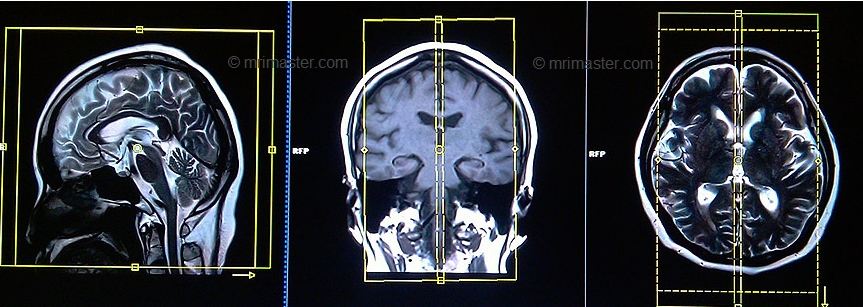 mri brain protocol and planning of sagital scans