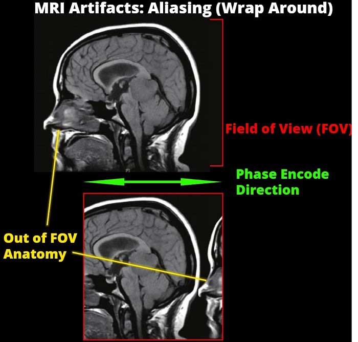 MR Artifacts Aliasing